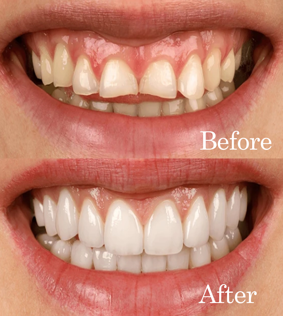 undefined before and after