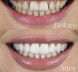 Before and after dental treatment comparison
